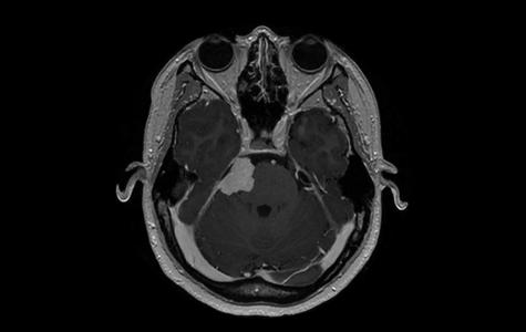 MRI scan of a meningioma.