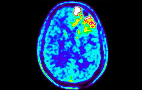 18F-FET image showing a brain tumor.