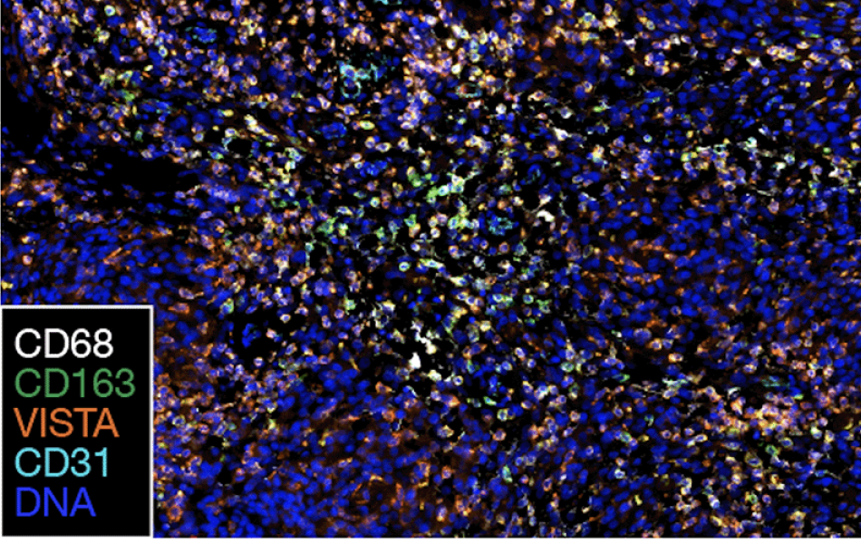 Multiplexed sequential immunofluorescence microscopy image of a primary meningioma.