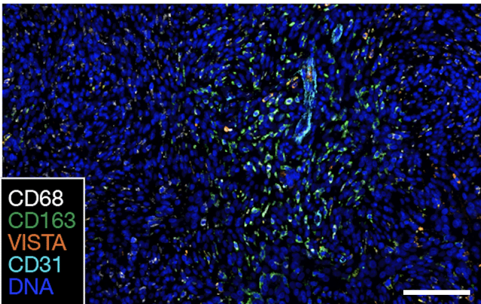 Multiplexed sequential immunofluorescence microscopy image of a recurrent meningioma.