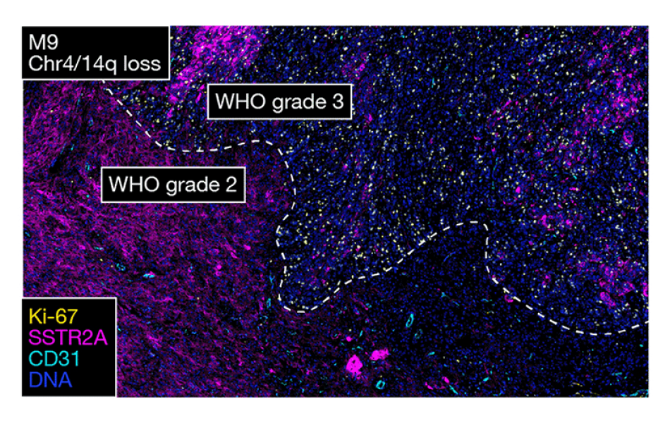 Immunofluorescence microscopy image showing WHO 2 and 3 meningioma 