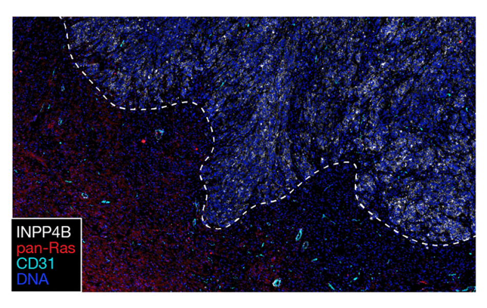 Immunofluorescence microscopy image showing WHO 2 and 3 meningioma side-by-side