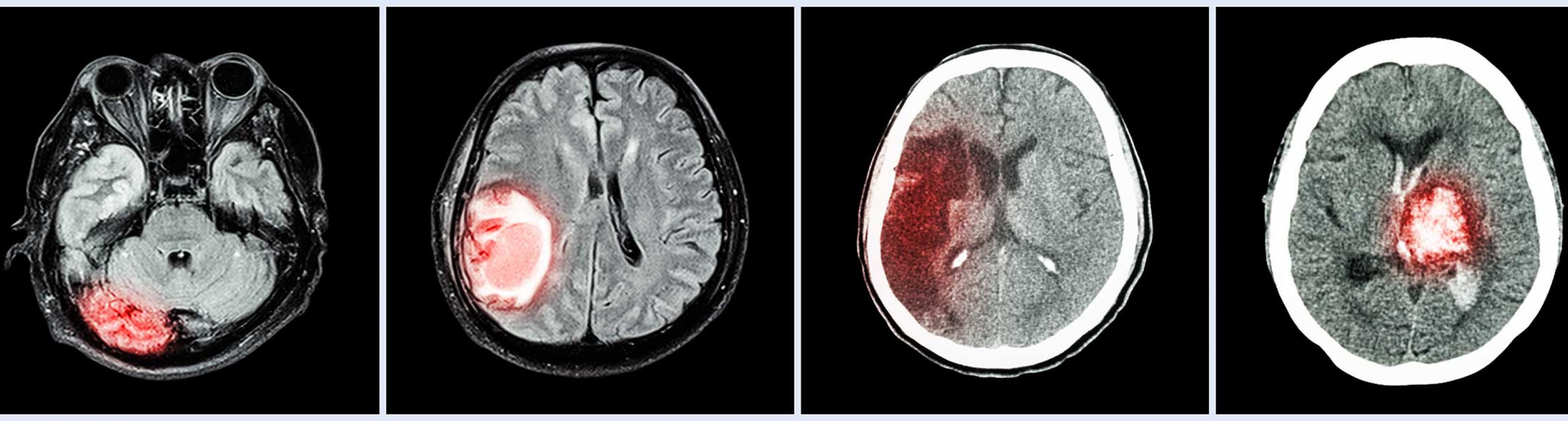 Treatments for Brain Tumors