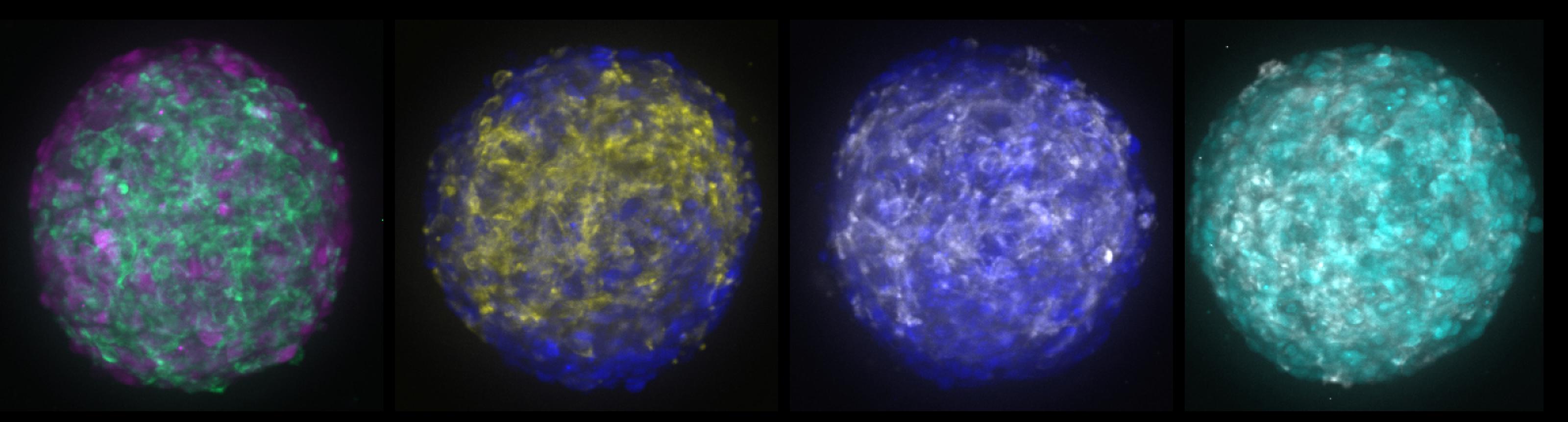 Meningioma organoid panel