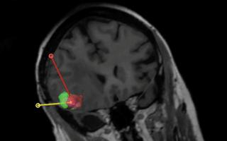 Convection enhanced delivery for brain tumors